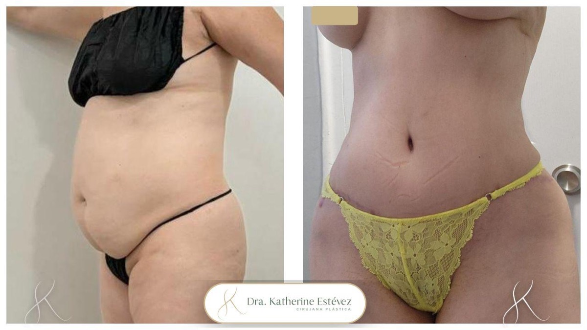 Abdominoplastia 3