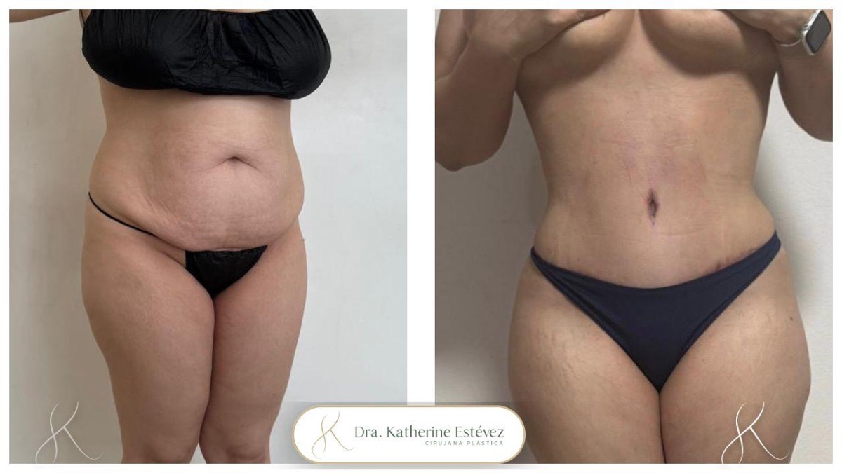 Abdominoplastia 4