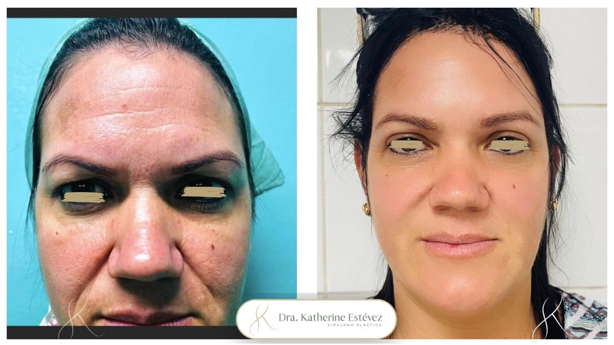 Blefaroplastia