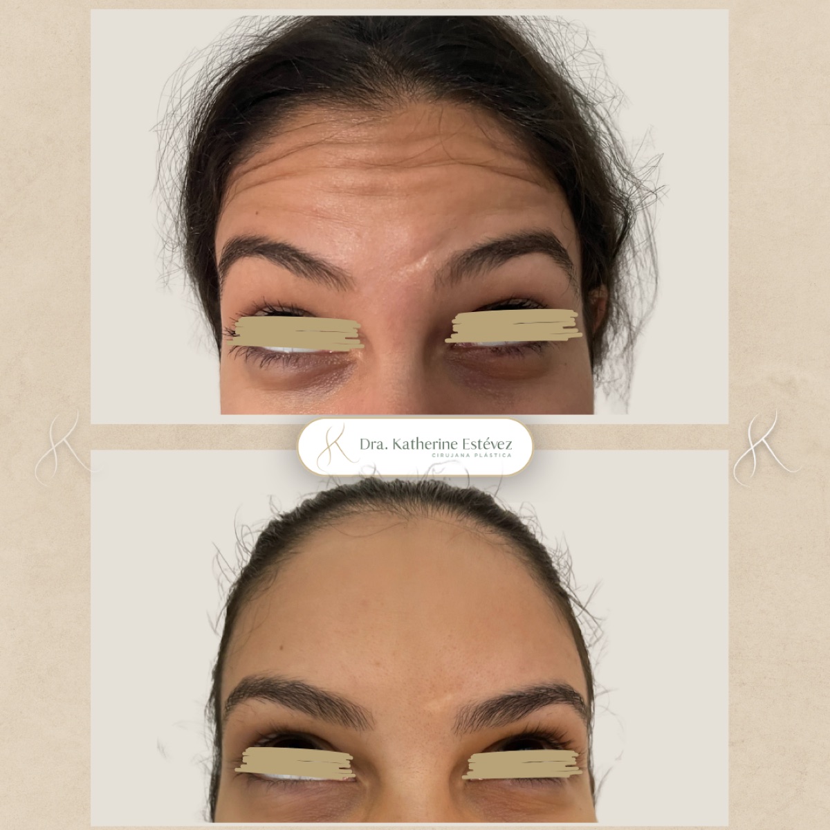 Botox 2