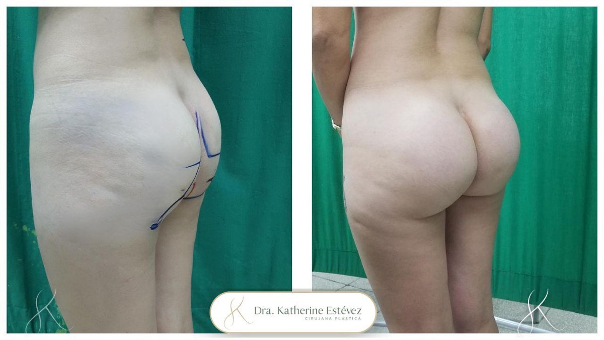 Gluteoplastia 2