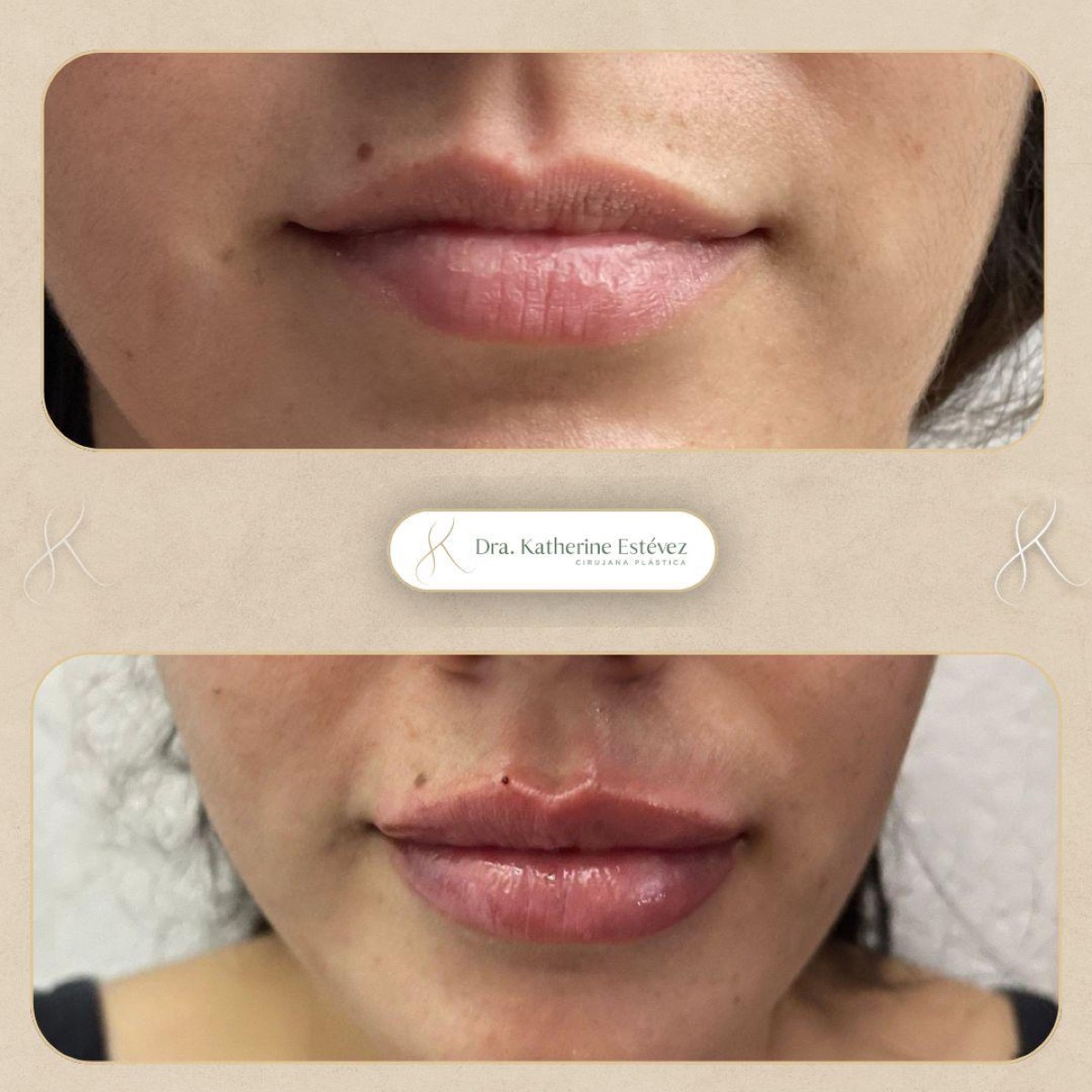 Aumento Labios