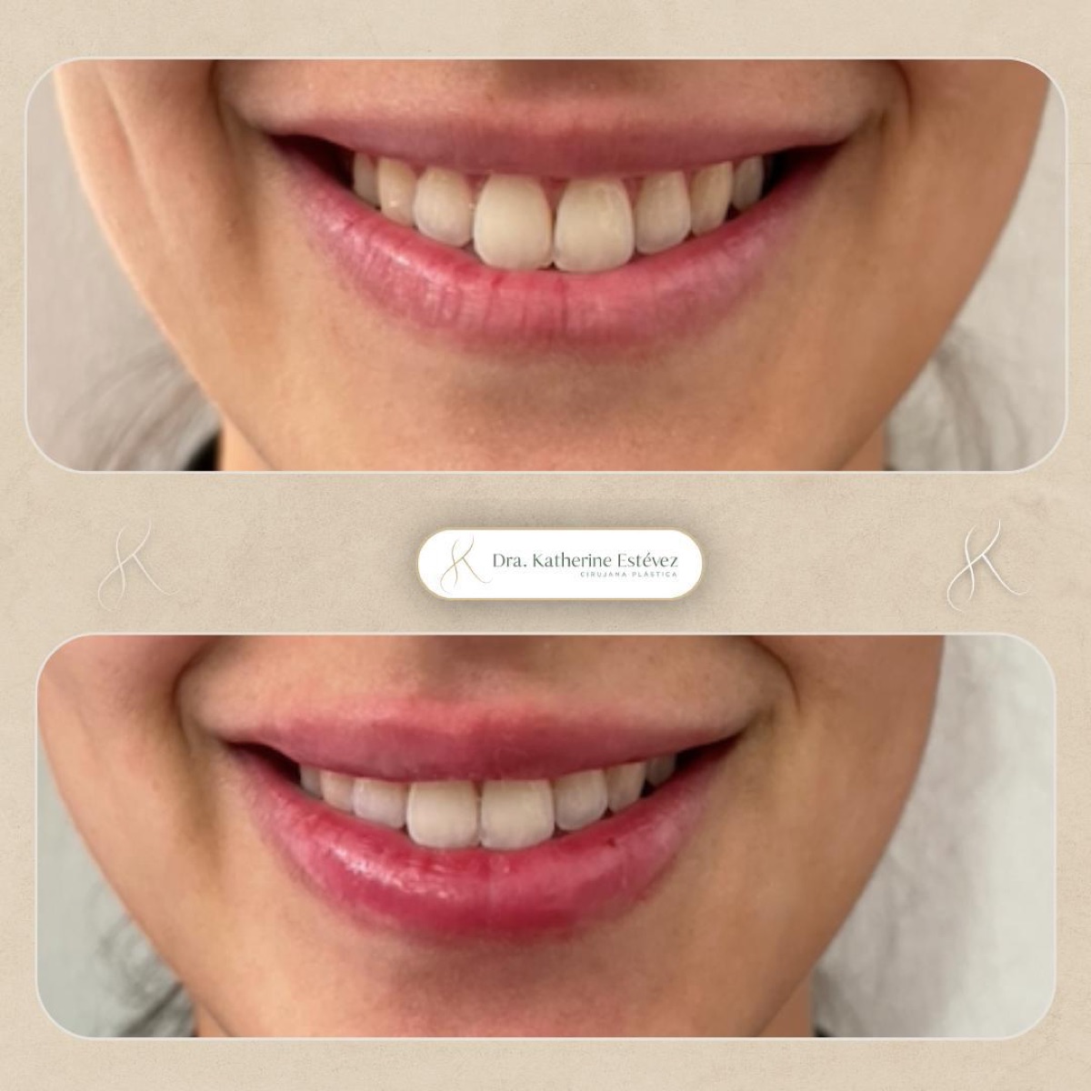 Aumento Labios 2