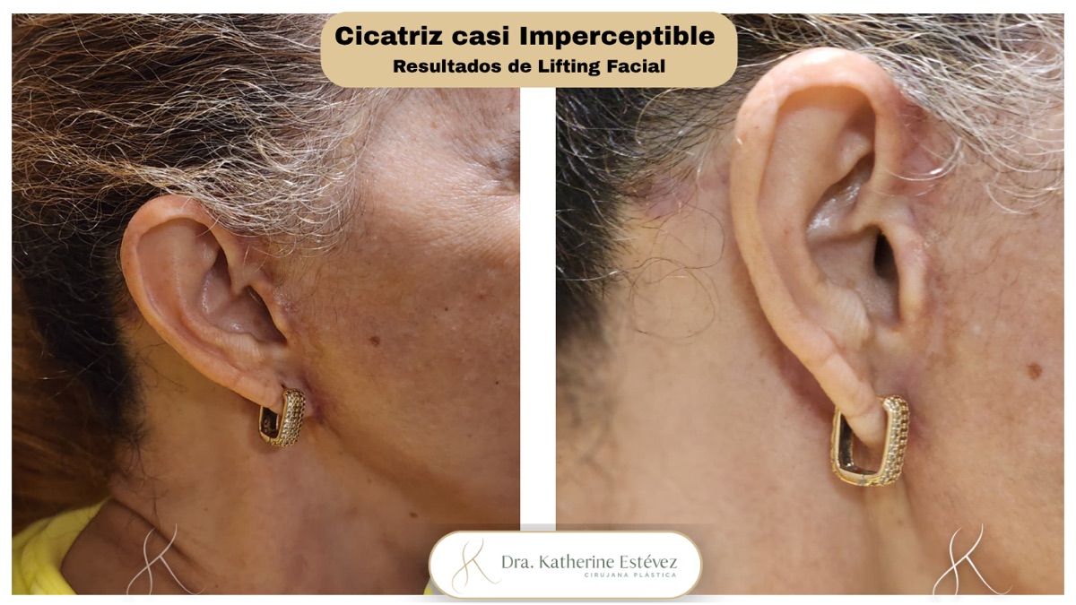 Lifting Facial