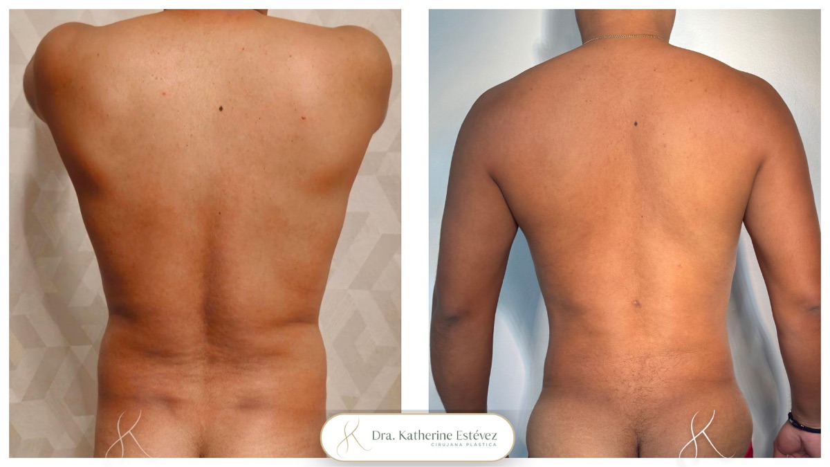 Lipoescultura Hombre