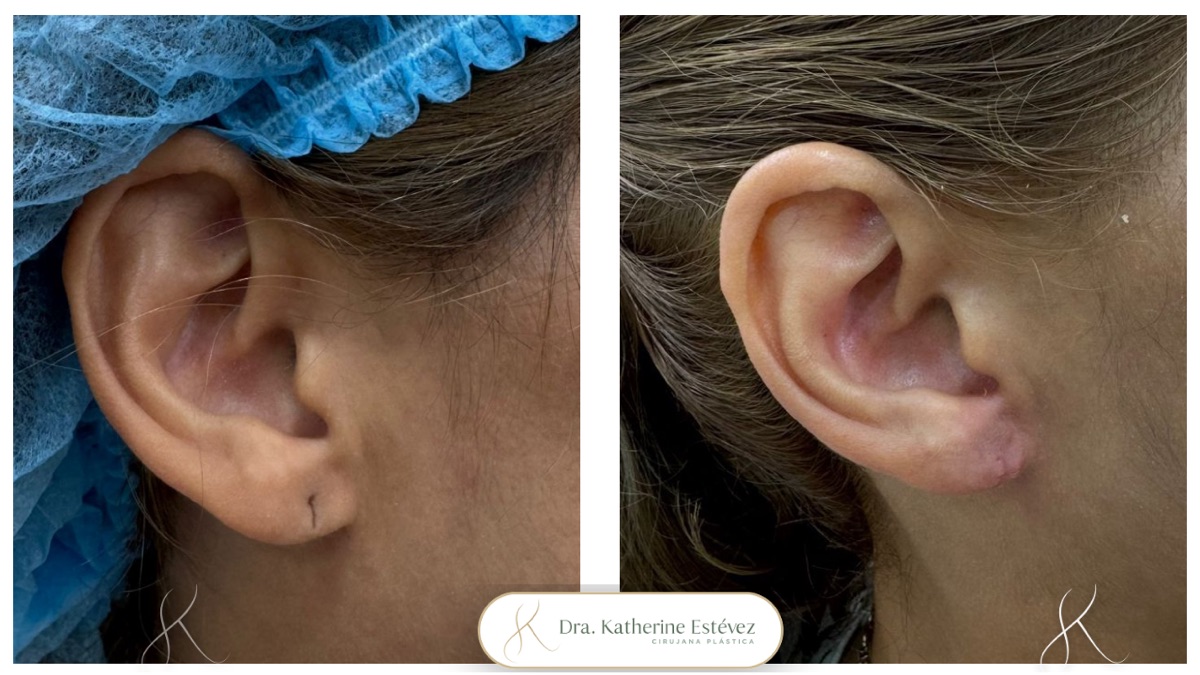Lobuloplastia