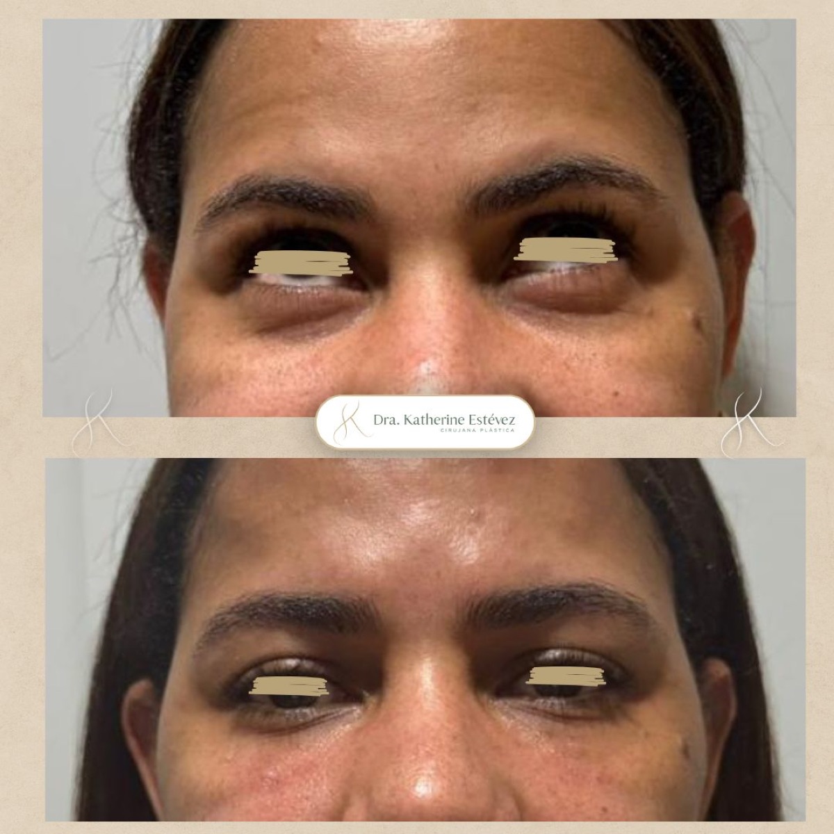 Ojeras