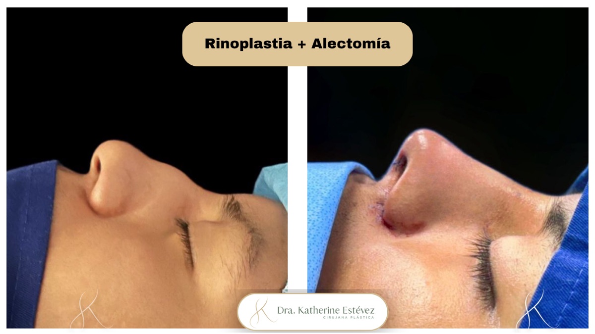 Rinoplastia