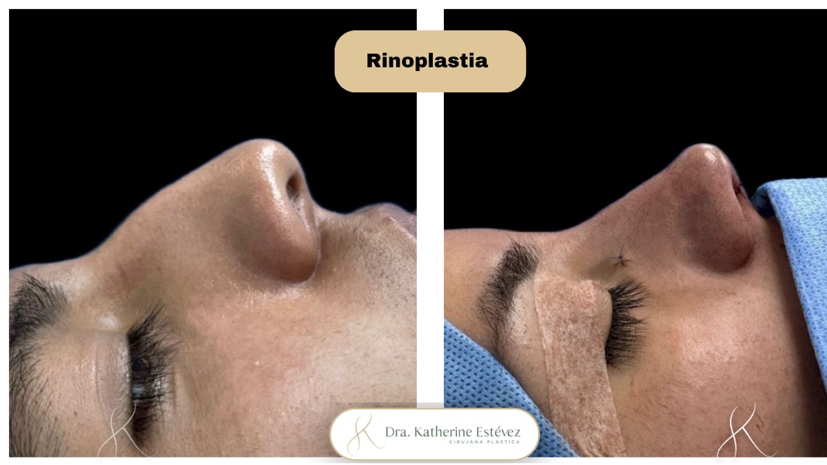Rinoplastia 2